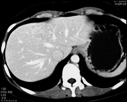 Focal Nodular Hyperplasia (FNH) - CTisus CT Scan