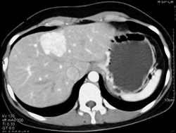 Focal Nodular Hyperplasia (FNH) - CTisus CT Scan