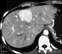 Focal Nodular Hyperplasia (FNH) - CTisus CT Scan