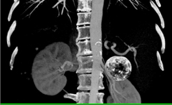 Cirrhosis With 1 Cm Hepatocellular Carcinoma (HCC) in Dome of Liver - CTisus CT Scan