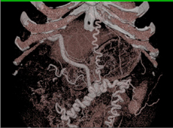 Cirrhosis With Large Abdominal Wall Varices - CTisus CT Scan