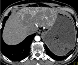 Giant Hemangioma - CTisus CT Scan