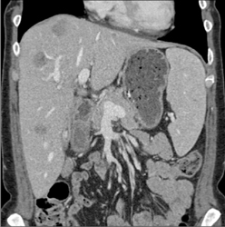 Liver Abscesses Angiomyolipoma (AML) Patient - CTisus CT Scan