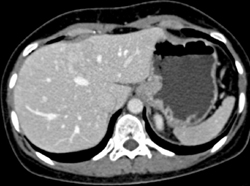 Focal Nodular Hyperplasia (FNH) - CTisus CT Scan