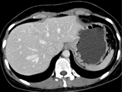 Focal Nodular Hyperplasia (FNH) - CTisus CT Scan