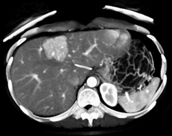 Focal Nodular Hyperplasia (FNH) - CTisus CT Scan