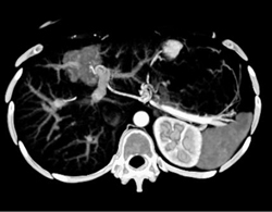 Focal Nodular Hyperplasia (FNH) - CTisus CT Scan