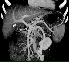 Cirrhosis - CTisus CT Scan