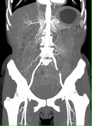 Hepatoma - CTisus CT Scan