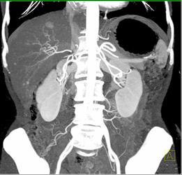 Hepatoma - CTisus CT Scan