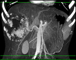 Giant Cavernous Hemangioma - CTisus CT Scan