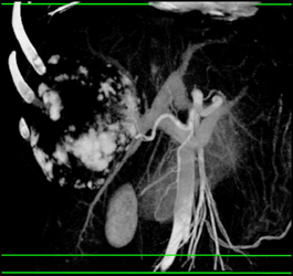 Giant Cavernous Hemangioma - CTisus CT Scan