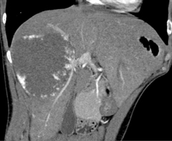 Giant Cavernous Hemangioma - CTisus CT Scan