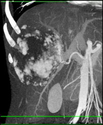 Giant Cavernous Hemangioma - CTisus CT Scan