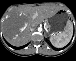 Giant Cavernous Hemangioma - CTisus CT Scan