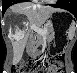 Giant Cavernous Hemangioma - CTisus CT Scan