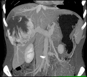 Giant Cavernous Hemangioma - CTisus CT Scan