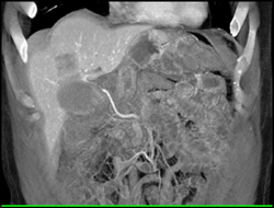 Cirrhosis and Gallbladder Cancer - CTisus CT Scan