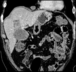 Gallbladder Cancer - CTisus CT Scan