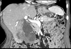 Gallbladder Cancer - CTisus CT Scan