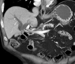 Cholangiocarcinoma - CTisus CT Scan