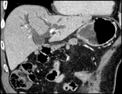 Cholangiocarcinoma - CTisus CT Scan