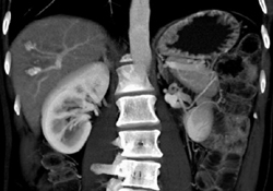 Arteriovenous Malformations (AVMs) - CTisus CT Scan