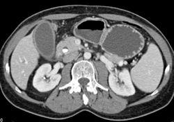 Acute Cholecystitis With Stones in Gallbladder - CTisus CT Scan