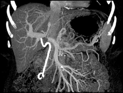 Narrowed Portal Vein Due to Tumor Encasement - CTisus CT Scan