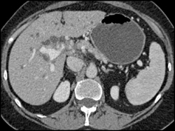 Tumor Encases Portal Vein - CTisus CT Scan