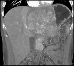 Hepatoma With Neovascularity - CTisus CT Scan