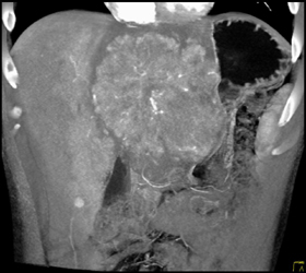 Hepatoma With Neovascularity - CTisus CT Scan