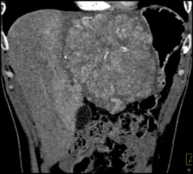 Hepatoma With Neovascularity - CTisus CT Scan