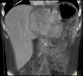 Hepatoma With Neovascularity - CTisus CT Scan