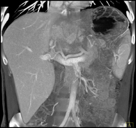 Hepatoma With Neovascularity - CTisus CT Scan