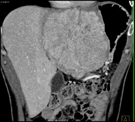 Hepatoma With Neovascularity - CTisus CT Scan