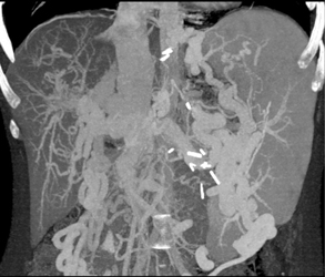 Cirrhosis With Portal Hypertension and Large Varices - CTisus CT Scan