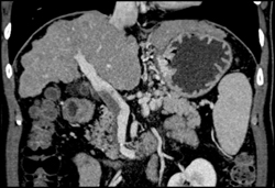 MIP Does Not Show Portal Vein Thrombosis (PVT) - CTisus CT Scan