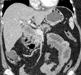 Carcinoma Arises in A Choledochal Cyst - CTisus CT Scan