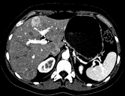 Focal Nodular Hyperplasia (FNH) - CTisus CT Scan