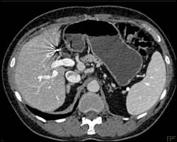 Post Cholecystectomy Bed - CTisus CT Scan