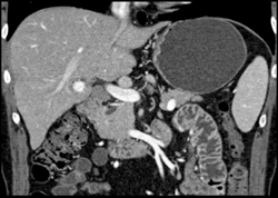 Hepatic Artery Aneurysm - CTisus CT Scan