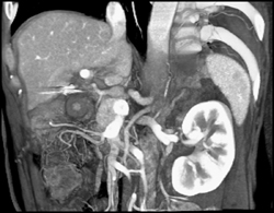 Hepatic Artery Aneurysm - CTisus CT Scan