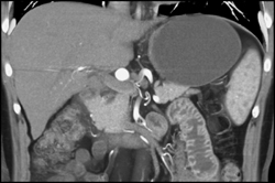 Hepatic Artery Aneurysm - CTisus CT Scan