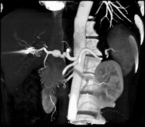 Hepatic Artery Aneurysm - CTisus CT Scan