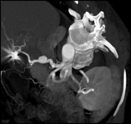 Hepatic Artery Aneurysm - CTisus CT Scan