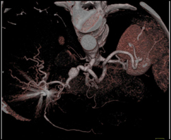 Hepatic Artery Aneurysm - CTisus CT Scan