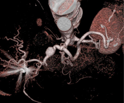 Hepatic Artery Aneurysm - CTisus CT Scan