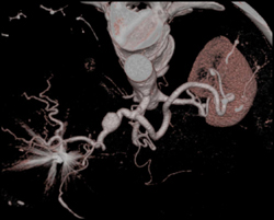 Hepatic Artery Aneurysm - CTisus CT Scan