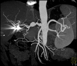 Hepatic Artery Aneurysm - CTisus CT Scan